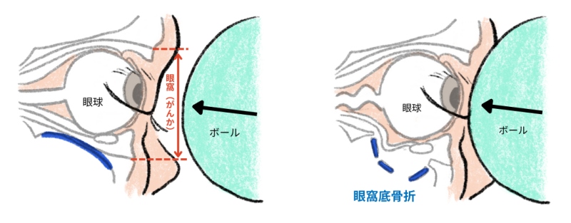 眼窩底骨折