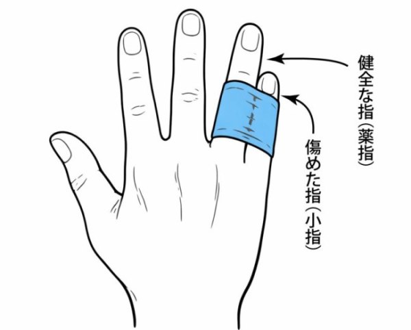 テーピングの一例（隣の指を支えにするバディ固定）
